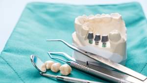 Close-Up auf Zahnarzt-Instrumente, drei Zähne und ein Zahnabdruck auf einem Tablett